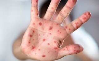 Первый случай нового штамма оспы обезьян в Швеции
